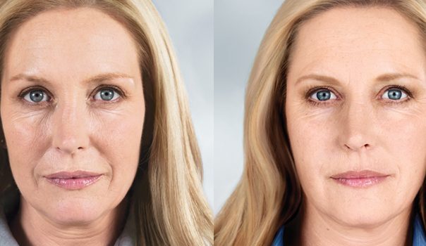 sculptra face before after