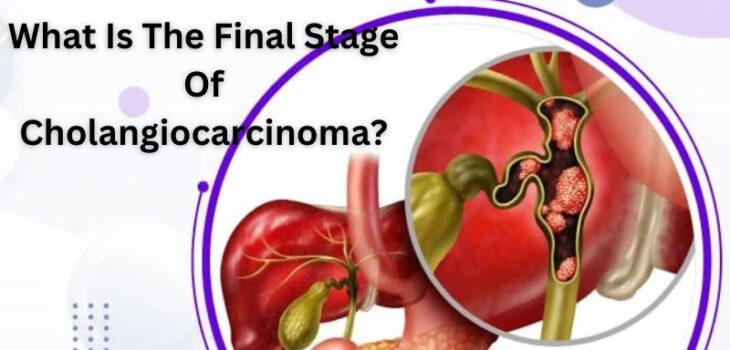 Cholangiocarcinoma