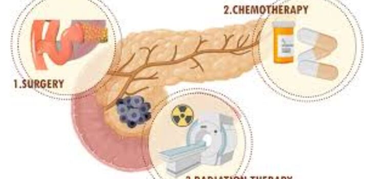 Pancreatic Cancer Treatment image (1)