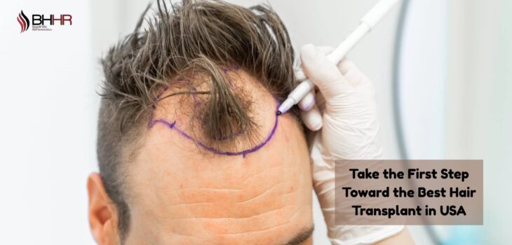 best hair transplant in usa