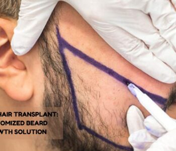 facial hair transplant