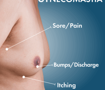 gynecomastia in islamabad