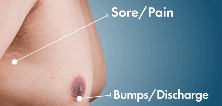 gynecomastia in islamabad