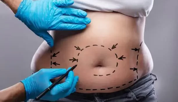 liposuction islamabad