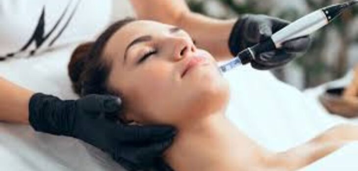 microneedling tretament images