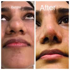 rhinoplasty cost in Pakistan