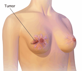Breast Cancer Care Costs in India