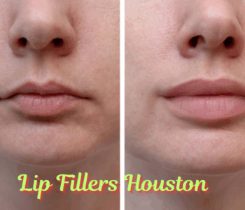 lip fillers Houston