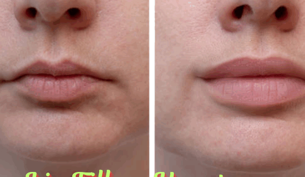lip fillers Houston