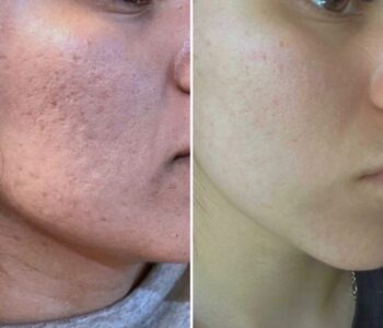 how much does microneedling cost