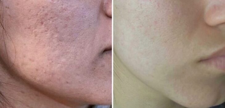 how much does microneedling cost